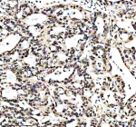 Immunohistochemical staining of RTRAF using anti-RTRAF antibody. RTRAF was detected in a paraffin-embedded section of human ovarian cancer tissue. Heat mediated antigen retrieval was performed in EDTA buffer (pH 8.0, epitope retrieval solution). The tissue section was blocked with 10% goat serum. The tissue section was then incubated with 2 ug/ml rabbit anti-RTRAF antibody overnight at 4oC. Peroxidase Conjugated Goat Anti-rabbit IgG was used as secondary antibody and incubated for 30 minutes at 37oC. The tissue section was developed using an HRP secondary and DAB substrate.