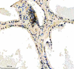 Immunohistochemical staining of RTRAF using anti-RTRAF antibody. RTRAF was detected in a paraffin-embedded section of human prostate cancer tissue. Heat mediated antigen retrieval was performed in EDTA buffer (pH 8.0, epitope retrieval solution). The tissue section was blocked with 10% goat serum. The tissue section was then incubated with 2 ug/ml rabbit anti-RTRAF antibody overnight at 4oC. Peroxidase Conjugated Goat Anti-rabbit IgG was used as secondary antibody and incubated for 30 minutes at 37oC. The tissue section was developed using an HRP secondary and DAB substrate.