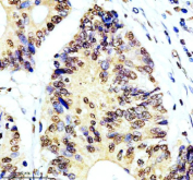 Immunohistochemical staining of MSL1 using anti-MSL1 antibody. MSL1 was detected in a paraffin-embedded section of human colon cancer tissue. Heat mediated antigen retrieval was performed in EDTA buffer (pH 8.0, epitope retrieval solution). The tissue section was blocked with 10% goat serum. The tissue section was then incubated with 2 ug/ml rabbit anti-MSL1 antibody overnight at 4oC. Peroxidase Conjugated Goat Anti-rabbit IgG was used as secondary antibody and incubated for 30 minutes at 37oC. The tissue section was developed using an HRP secondary and DAB substrate.