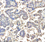 Immunohistochemical staining of ASCL1 using anti-ASCL1 antibody. ASCL1 was detected in a paraffin-embedded section of human lung cancer tissue. Heat mediated antigen retrieval was performed in EDTA buffer (pH 8.0, epitope retrieval solution). The tissue section was blocked with 10% goat serum. The tissue section was then incubated with 2 ug/ml rabbit anti-ASCL1 antibody overnight at 4oC. Peroxidase Conjugated Goat Anti-rabbit IgG was used as secondary antibody and incubated for 30 minutes at 37oC. The tissue section was developed using an HRP secondary and DAB substrate.