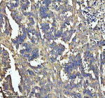 Immunohistochemical staining of SOS1 using anti-SOS1 antibody. SOS1 was detected in a paraffin-embedded section of human colon cancer tissue. Heat mediated antigen retrieval was performed in EDTA buffer (pH 8.0, epitope retrieval solution). The tissue section was blocked with 10% goat serum. The tissue section was then incubated with 2 ug/ml rabbit anti-SOS1 antibody overnight at 4oC. Peroxidase Conjugated Goat Anti-rabbit IgG was used as secondary antibody and incubated for 30 minutes at 37oC. The tissue section was developed using an HRP secondary and DAB substrate.