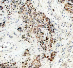 Immunohistochemical staining of TCIRG1 using anti-TCIRG1 antibody. TCIRG1 was detected in a paraffin-embedded section of human lung cancer tissue. Heat mediated antigen retrieval was performed in EDTA buffer (pH 8.0, epitope retrieval solution). The tissue section was blocked with 10% goat serum. The tissue section was then incubated with 2 ug/ml rabbit anti-TCIRG1 antibody overnight at 4oC. Peroxidase Conjugated Goat Anti-rabbit IgG was used as secondary antibody and incubated for 30 minutes at 37oC. The tissue section was developed using an HRP secondary and DAB substrate. Lung carcinoma section shows granular cytoplasmic and membranous staining in tumor-associated macrophages and scattered carcinoma cells, consistent with localization of the vacuolar-ATPase a3 subunit to acidified vesicular and plasma membrane regions.