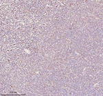 Immunohistochemical staining of ORC2 using anti-ORC2 antibody. ORC2 was detected in a paraffin-embedded section of diffuse large B-cell lymphoma of human intestine tissue. Heat mediated antigen retrieval was performed in EDTA buffer (pH 8.0, epitope retrieval solution). The tissue section was blocked with 10% goat serum. The tissue section was then incubated with 2 ug/ml rabbit anti-ORC2 antibody overnight at 4oC. Peroxidase Conjugated Goat Anti-rabbit IgG was used as secondary antibody and incubated for 30 minutes at 37oC. The tissue section was developed using an HRP secondary and DAB substrate.