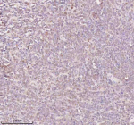 Immunohistochemical staining of ORC2 using anti-ORC2 antibody. ORC2 was detected in a paraffin-embedded section of diffuse large B-cell lymphoma of human intestine tissue. Heat mediated antigen retrieval was performed in EDTA buffer (pH 8.0, epitope retrieval solution). The tissue section was blocked with 10% goat serum. The tissue section was then incubated with 2 ug/ml rabbit anti-ORC2 antibody overnight at 4oC. Peroxidase Conjugated Goat Anti-rabbit IgG was used as secondary antibody and incubated for 30 minutes at 37oC. The tissue section was developed using an HRP secondary and DAB substrate.