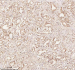 Immunohistochemical staining of ORC2 using anti-ORC2 antibody. ORC2 was detected in a paraffin-embedded section of human prostate adenocarcinoma tissue. Heat mediated antigen retrieval was performed in EDTA buffer (pH 8.0, epitope retrieval solution). The tissue section was blocked with 10% goat serum. The tissue section was then incubated with 2 ug/ml rabbit anti-ORC2 antibody overnight at 4oC. Peroxidase Conjugated Goat Anti-rabbit IgG was used as secondary antibody and incubated for 30 minutes at 37oC. The tissue section was developed using an HRP secondary and DAB substrate.
