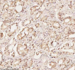 Immunohistochemical staining of ORC2 using anti-ORC2 antibody. ORC2 was detected in a paraffin-embedded section of human prostate adenocarcinoma tissue. Heat mediated antigen retrieval was performed in EDTA buffer (pH 8.0, epitope retrieval solution). The tissue section was blocked with 10% goat serum. The tissue section was then incubated with 2 ug/ml rabbit anti-ORC2 antibody overnight at 4oC. Peroxidase Conjugated Goat Anti-rabbit IgG was used as secondary antibody and incubated for 30 minutes at 37oC. The tissue section was developed using an HRP secondary and DAB substrate.