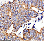 Immunohistochemical staining of RB1CC1 using anti-RB1CC1 antibody. RB1CC1 was detected in a paraffin-embedded section of human colon cancer tissue. Heat mediated antigen retrieval was performed in EDTA buffer (pH 8.0, epitope retrieval solution). The tissue section was blocked with 10% goat serum. The tissue section was then incubated with 2 ug/ml rabbit anti-RB1CC1 antibody overnight at 4oC. Peroxidase Conjugated Goat Anti-rabbit IgG was used as secondary antibody and incubated for 30 minutes at 37oC. The tissue section was developed using an HRP secondary and DAB substrate.