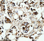 Immunohistochemical staining of RB1CC1 using anti-RB1CC1 antibody. RB1CC1 was detected in a paraffin-embedded section of human breast cancer tissue. Heat mediated antigen retrieval was performed in EDTA buffer (pH 8.0, epitope retrieval solution). The tissue section was blocked with 10% goat serum. The tissue section was then incubated with 2 ug/ml rabbit anti-RB1CC1 antibody overnight at 4oC. Peroxidase Conjugated Goat Anti-rabbit IgG was used as secondary antibody and incubated for 30 minutes at 37oC. The tissue section was developed using an HRP secondary and DAB substrate.