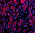 Immunofluorescent staining of RB1CC1 using anti-RB1CC1 antibody (red). RB1CC1 was detected in a paraffin-embedded section of human breast cancer tissue. Heat mediated antigen retrieval was performed in EDTA buffer (pH 8.0, epitope retrieval solution). The tissue section was blocked with 10% goat serum. The tissue section was then incubated with 5 ug/ml rabbit anti-RB1CC1 antibody overnight at 4oC. Cy3 Conjugated Goat Anti-Rabbit IgG was used as secondary antibody at 1:500 dilution and incubated for 30 minutes at 37oC. The section was counterstained with DAPI nuclear stain (blue). Visualize using a fluorescence microscope and filter sets appropriate for the label used.