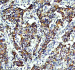 Immunohistochemical staining of SLIRP using anti-SLIRP antibody. SLIRP was detected in a paraffin-embedded section of human stomach cancer tissue. Heat mediated antigen retrieval was performed in EDTA buffer (pH 8.0, epitope retrieval solution). The tissue section was blocked with 10% goat serum. The tissue section was then incubated with 2 ug/ml rabbit anti-SLIRP antibody overnight at 4oC. Peroxidase Conjugated Goat Anti-rabbit IgG was used as secondary antibody and incubated for 30 minutes at 37oC. The tissue section was developed using an HRP secondary and DAB substrate.
