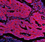 Immunofluorescent staining of SLIRP using anti-SLIRP antibody (red). SLIRP was detected in a paraffin-embedded section of human colon cancer tissue. Heat mediated antigen retrieval was performed in EDTA buffer (pH 8.0, epitope retrieval solution). The tissue section was blocked with 10% goat serum. The tissue section was then incubated with 5 ug/ml rabbit anti-SLIRP antibody overnight at 4oC. Cy3 Conjugated Goat Anti-Rabbit IgG was used as secondary antibody at 1:500 dilution and incubated for 30 minutes at 37oC. The section was counterstained with DAPI nuclear stain (blue). Visualize using a fluorescence microscope and filter sets appropriate for the label used.