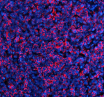 Immunofluorescent staining of SLIRP using anti-SLIRP antibody (red). SLIRP was detected in a paraffin-embedded section of human stomach cancer tissue. Heat mediated antigen retrieval was performed in EDTA buffer (pH 8.0, epitope retrieval solution). The tissue section was blocked with 10% goat serum. The tissue section was then incubated with 5 ug/ml rabbit anti-SLIRP antibody overnight at 4oC. Cy3 Conjugated Goat Anti-Rabbit IgG was used as secondary antibody at 1:500 dilution and incubated for 30 minutes at 37oC. The section was counterstained with DAPI nuclear stain (blue). Visualize using a fluorescence microscope and filter sets appropriate for the label used.