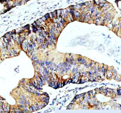 Immunohistochemical staining of SLIRP using anti-SLIRP antibody. SLIRP was detected in a paraffin-embedded section of human colon cancer tissue. Heat mediated antigen retrieval was performed in EDTA buffer (pH 8.0, epitope retrieval solution). The tissue section was blocked with 10% goat serum. The tissue section was then incubated with 2 ug/ml rabbit anti-SLIRP antibody overnight at 4oC. Peroxidase Conjugated Goat Anti-rabbit IgG was used as secondary antibody and incubated for 30 minutes at 37oC. The tissue section was developed using an HRP secondary and DAB substrate.