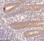 Immunohistochemical staining of SCAMP3 using anti-SCAMP3 antibody. SCAMP3 was detected in a paraffin-embedded section of human appendiceal carcinoid tissue. Heat mediated antigen retrieval was performed in EDTA buffer (pH 8.0, epitope retrieval solution). The tissue section was blocked with 10% goat serum. The tissue section was then incubated with 2 ug/ml rabbit anti-SCAMP3 antibody overnight at 4oC. Peroxidase Conjugated Goat Anti-rabbit IgG was used as secondary antibody and incubated for 30 minutes at 37oC. The tissue section was developed using an HRP secondary and DAB substrate.