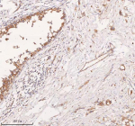 Immunohistochemical staining of SCAMP3 using anti-SCAMP3 antibody. SCAMP3 was detected in a paraffin-embedded section of human breast cancer tissue. Heat mediated antigen retrieval was performed in EDTA buffer (pH 8.0, epitope retrieval solution). The tissue section was blocked with 10% goat serum. The tissue section was then incubated with 2 ug/ml rabbit anti-SCAMP3 antibody overnight at 4oC. Peroxidase Conjugated Goat Anti-rabbit IgG was used as secondary antibody and incubated for 30 minutes at 37oC. The tissue section was developed using an HRP secondary and DAB substrate.