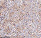 Immunohistochemical staining of SCAMP3 using anti-SCAMP3 antibody. SCAMP3 was detected in a paraffin-embedded section of human testicular seminoma tissue. Heat mediated antigen retrieval was performed in EDTA buffer (pH 8.0, epitope retrieval solution). The tissue section was blocked with 10% goat serum. The tissue section was then incubated with 2 ug/ml rabbit anti-SCAMP3 antibody overnight at 4oC. Peroxidase Conjugated Goat Anti-rabbit IgG was used as secondary antibody and incubated for 30 minutes at 37oC. The tissue section was developed using an HRP secondary and DAB substrate.