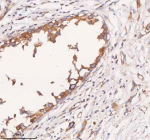 Immunohistochemical staining of SCAMP3 using anti-SCAMP3 antibody. SCAMP3 was detected in a paraffin-embedded section of human breast cancer tissue. Heat mediated antigen retrieval was performed in EDTA buffer (pH 8.0, epitope retrieval solution). The tissue section was blocked with 10% goat serum. The tissue section was then incubated with 2 ug/ml rabbit anti-SCAMP3 antibody overnight at 4oC. Peroxidase Conjugated Goat Anti-rabbit IgG was used as secondary antibody and incubated for 30 minutes at 37oC. The tissue section was developed using an HRP secondary and DAB substrate.