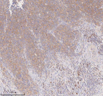 Immunohistochemical staining of SCAMP3 using anti-SCAMP3 antibody. SCAMP3 was detected in a paraffin-embedded section of human cervix squamous cell carcinoma tissue. Heat mediated antigen retrieval was performed in EDTA buffer (pH 8.0, epitope retrieval solution). The tissue section was blocked with 10% goat serum. The tissue section was then incubated with 2 ug/ml rabbit anti-SCAMP3 antibody overnight at 4oC. Peroxidase Conjugated Goat Anti-rabbit IgG was used as secondary antibody and incubated for 30 minutes at 37oC. The tissue section was developed using an HRP secondary and DAB substrate.