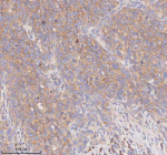 Immunohistochemical staining of SCAMP3 using anti-SCAMP3 antibody. SCAMP3 was detected in a paraffin-embedded section of human cervix squamous cell carcinoma tissue. Heat mediated antigen retrieval was performed in EDTA buffer (pH 8.0, epitope retrieval solution). The tissue section was blocked with 10% goat serum. The tissue section was then incubated with 2 ug/ml rabbit anti-SCAMP3 antibody overnight at 4oC. Peroxidase Conjugated Goat Anti-rabbit IgG was used as secondary antibody and incubated for 30 minutes at 37oC. The tissue section was developed using an HRP secondary and DAB substrate.