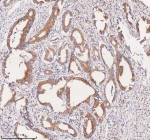 Immunohistochemical staining of SCAMP3 using anti-SCAMP3 antibody. SCAMP3 was detected in a paraffin-embedded section of human rectum adenocarcinoma tissue. Heat mediated antigen retrieval was performed in EDTA buffer (pH 8.0, epitope retrieval solution). The tissue section was blocked with 10% goat serum. The tissue section was then incubated with 2 ug/ml rabbit anti-SCAMP3 antibody overnight at 4oC. Peroxidase Conjugated Goat Anti-rabbit IgG was used as secondary antibody and incubated for 30 minutes at 37oC. The tissue section was developed using an HRP secondary and DAB substrate.