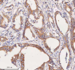 Immunohistochemical staining of SCAMP3 using anti-SCAMP3 antibody. SCAMP3 was detected in a paraffin-embedded section of human rectum adenocarcinoma tissue. Heat mediated antigen retrieval was performed in EDTA buffer (pH 8.0, epitope retrieval solution). The tissue section was blocked with 10% goat serum. The tissue section was then incubated with 2 ug/ml rabbit anti-SCAMP3 antibody overnight at 4oC. Peroxidase Conjugated Goat Anti-rabbit IgG was used as secondary antibody and incubated for 30 minutes at 37oC. The tissue section was developed using an HRP secondary and DAB substrate.