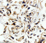 Immunohistochemical staining of EMC1 using anti-EMC1 antibody. EMC1 was detected in a paraffin-embedded section of human breast cancer tissue. Heat mediated antigen retrieval was performed in EDTA buffer (pH 8.0, epitope retrieval solution). The tissue section was blocked with 10% goat serum. The tissue section was then incubated with 2 ug/ml rabbit anti-EMC1 antibody overnight at 4oC. Peroxidase Conjugated Goat Anti-rabbit IgG was used as secondary antibody and incubated for 30 minutes at 37oC. The tissue section was developed using an HRP secondary and DAB substrate.
