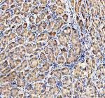 Immunohistochemical staining of MVK using anti-MVK antibody. MVK was detected in a paraffin-embedded section of human liver cancer tissue. Heat mediated antigen retrieval was performed in EDTA buffer (pH 8.0, epitope retrieval solution). The tissue section was blocked with 10% goat serum. The tissue section was then incubated with 2 ug/ml rabbit anti-MVK antibody overnight at 4oC. Peroxidase Conjugated Goat Anti-rabbit IgG was used as secondary antibody and incubated for 30 minutes at 37oC. The tissue section was developed using an HRP secondary and DAB substrate.