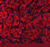 Immunofluorescent staining of MVK using anti-MVK antibody (red). MVK was detected in a paraffin-embedded section of human liver cancer tissue. Heat mediated antigen retrieval was performed in EDTA buffer (pH 8.0, epitope retrieval solution). The tissue section was blocked with 10% goat serum. The tissue section was then incubated with 5 ug/ml rabbit anti-MVK antibody overnight at 4oC. Cy3 Conjugated Goat Anti-Rabbit IgG was used as secondary antibody at 1:500 dilution and incubated for 30 minutes at 37oC. The section was counterstained with DAPI nuclear stain (blue). Visualize using a fluorescence microscope and filter sets appropriate for the label used.