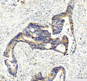 Immunohistochemical staining of MVK using anti-MVK antibody. MVK was detected in a paraffin-embedded section of human colon cancer tissue. Heat mediated antigen retrieval was performed in EDTA buffer (pH 8.0, epitope retrieval solution). The tissue section was blocked with 10% goat serum. The tissue section was then incubated with 2 ug/ml rabbit anti-MVK antibody overnight at 4oC. Peroxidase Conjugated Goat Anti-rabbit IgG was used as secondary antibody and incubated for 30 minutes at 37oC. The tissue section was developed using an HRP secondary and DAB substrate.