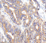 Immunohistochemical staining of RAB27B using anti-RAB27B antibody. RAB27B was detected in a paraffin-embedded section of human stomach cancer tissue. Heat mediated antigen retrieval was performed in EDTA buffer (pH 8.0, epitope retrieval solution). The tissue section was blocked with 10% goat serum. The tissue section was then incubated with 2 ug/ml rabbit anti-RAB27B antibody overnight at 4oC. Peroxidase Conjugated Goat Anti-rabbit IgG was used as secondary antibody and incubated for 30 minutes at 37oC. The tissue section was developed using an HRP secondary and DAB substrate.