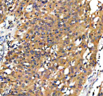 Immunohistochemical staining of GPD1 using anti-GPD1 antibody. GPD1 was detected in a paraffin-embedded section of human bladder cancer tissue. Heat mediated antigen retrieval was performed in EDTA buffer (pH 8.0, epitope retrieval solution). The tissue section was blocked with 10% goat serum. The tissue section was then incubated with 2 ug/ml rabbit anti-GPD1 antibody overnight at 4oC. Peroxidase Conjugated Goat Anti-rabbit IgG was used as secondary antibody and incubated for 30 minutes at 37oC. The tissue section was developed using an HRP secondary and DAB substrate.