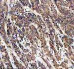 Immunohistochemical staining of TRIM32 using anti-TRIM32 antibody. TRIM32 was detected in a paraffin-embedded section of human colon cancer tissue. Heat mediated antigen retrieval was performed in EDTA buffer (pH 8.0, epitope retrieval solution). The tissue section was blocked with 10% goat serum. The tissue section was then incubated with 2 ug/ml rabbit anti-TRIM32 antibody overnight at 4oC. Peroxidase Conjugated Goat Anti-rabbit IgG was used as secondary antibody and incubated for 30 minutes at 37oC. The tissue section was developed using an HRP secondary and DAB substrate.