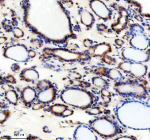 Immunohistochemical staining of TRIM32 using anti-TRIM32 antibody. TRIM32 was detected in a paraffin-embedded section of human thyroid cancer tissue. Heat mediated antigen retrieval was performed in EDTA buffer (pH 8.0, epitope retrieval solution). The tissue section was blocked with 10% goat serum. The tissue section was then incubated with 2 ug/ml rabbit anti-TRIM32 antibody overnight at 4oC. Peroxidase Conjugated Goat Anti-rabbit IgG was used as secondary antibody and incubated for 30 minutes at 37oC. The tissue section was developed using an HRP secondary and DAB substrate.