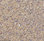 Immunohistochemical staining of TRIM2 using anti-TRIM2 antibody. TRIM2 was detected in a paraffin-embedded section of human glioblastoma tissue. Heat mediated antigen retrieval was performed in EDTA buffer (pH 8.0, epitope retrieval solution). The tissue section was blocked with 10% goat serum. The tissue section was then incubated with 2 ug/ml rabbit anti-TRIM2 antibody overnight at 4oC. Peroxidase Conjugated Goat Anti-rabbit IgG was used as secondary antibody and incubated for 30 minutes at 37oC. The tissue section was developed using an HRP secondary and DAB substrate.