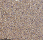 Immunohistochemical staining of TRIM2 using anti-TRIM2 antibody. TRIM2 was detected in a paraffin-embedded section of human glioblastoma tissue. Heat mediated antigen retrieval was performed in EDTA buffer (pH 8.0, epitope retrieval solution). The tissue section was blocked with 10% goat serum. The tissue section was then incubated with 2 ug/ml rabbit anti-TRIM2 antibody overnight at 4oC. Peroxidase Conjugated Goat Anti-rabbit IgG was used as secondary antibody and incubated for 30 minutes at 37oC. The tissue section was developed using an HRP secondary and DAB substrate.