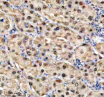 Immunohistochemical staining of TKFC using anti-TKFC antibody. TKFC was detected in a paraffin-embedded section of human liver cancer tissue. Heat mediated antigen retrieval was performed in EDTA buffer (pH 8.0, epitope retrieval solution). The tissue section was blocked with 10% goat serum. The tissue section was then incubated with 2 ug/ml rabbit anti-TKFC antibody overnight at 4oC. Peroxidase Conjugated Goat Anti-rabbit IgG was used as secondary antibody and incubated for 30 minutes at 37oC. The tissue section was developed using an HRP secondary and DAB substrate.