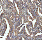 Immunohistochemical staining of STRIP1 using anti-STRIP1 antibody. STRIP1 was detected in a paraffin-embedded section of human colon cancer tissue. Heat mediated antigen retrieval was performed in EDTA buffer (pH 8.0, epitope retrieval solution). The tissue section was blocked with 10% goat serum. The tissue section was then incubated with 2 ug/ml rabbit anti-STRIP1 antibody overnight at 4oC. Peroxidase Conjugated Goat Anti-rabbit IgG was used as secondary antibody and incubated for 30 minutes at 37oC. The tissue section was developed using an HRP secondary and DAB substrate.