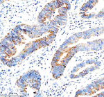 Immunohistochemical staining of IFI44L using anti-IFI44L antibody. IFI44L was detected in a paraffin-embedded section of human stomach cancer tissue. Heat mediated antigen retrieval was performed in EDTA buffer (pH 8.0, epitope retrieval solution). The tissue section was blocked with 10% goat serum. The tissue section was then incubated with 2 ug/ml rabbit anti-IFI44L antibody overnight at 4oC. Peroxidase Conjugated Goat Anti-rabbit IgG was used as secondary antibody and incubated for 30 minutes at 37oC. The tissue section was developed using an HRP secondary and DAB substrate.