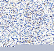 Immunohistochemical staining of IFI44L using anti-IFI44L antibody. IFI44L was detected in a paraffin-embedded section of human non-small cell lung cancer tissue. Heat mediated antigen retrieval was performed in EDTA buffer (pH 8.0, epitope retrieval solution). The tissue section was blocked with 10% goat serum. The tissue section was then incubated with 2 ug/ml rabbit anti-IFI44L antibody overnight at 4oC. Peroxidase Conjugated Goat Anti-rabbit IgG was used as secondary antibody and incubated for 30 minutes at 37oC. The tissue section was developed using an HRP secondary and DAB substrate.