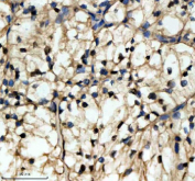 Immunohistochemical staining of NMNAT1 using anti-NMNAT1 antibody. NMNAT1 was detected in a paraffin-embedded section of human renal cancer tissue. Heat mediated antigen retrieval was performed in EDTA buffer (pH 8.0, epitope retrieval solution). The tissue section was blocked with 10% goat serum. The tissue section was then incubated with 2 ug/ml rabbit anti-NMNAT1 antibody overnight at 4oC. Peroxidase Conjugated Goat Anti-rabbit IgG was used as secondary antibody and incubated for 30 minutes at 37oC. The tissue section was developed using an HRP secondary and DAB substrate.