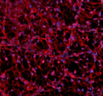 Immunofluorescent staining of NMNAT1 using anti-NMNAT1 antibody (red). NMNAT1 was detected in a paraffin-embedded section of human renal cancer tissue. Heat mediated antigen retrieval was performed in EDTA buffer (pH 8.0, epitope retrieval solution). The tissue section was blocked with 10% goat serum. The tissue section was then incubated with 5 ug/ml rabbit anti-NMNAT1 antibody overnight at 4oC. Cy3 Conjugated Goat Anti-Rabbit IgG was used as secondary antibody at 1:500 dilution and incubated for 30 minutes at 37oC. The section was counterstained with DAPI nuclear stain (blue). Visualize using a fluorescence microscope and filter sets appropriate for the label used.