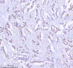 Immunohistochemical staining of SASS6 using anti-SASS6 antibody. SASS6 was detected in a paraffin-embedded section of human breast cancer tissue. Heat mediated antigen retrieval was performed in EDTA buffer (pH 8.0, epitope retrieval solution). The tissue section was blocked with 10% goat serum. The tissue section was then incubated with 2 ug/ml rabbit anti-SASS6 antibody overnight at 4oC. Peroxidase Conjugated Goat Anti-rabbit IgG was used as secondary antibody and incubated for 30 minutes at 37oC. The tissue section was developed using an HRP secondary and DAB substrate.