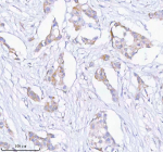Immunohistochemical staining of SASS6 using anti-SASS6 antibody. SASS6 was detected in a paraffin-embedded section of human breast cancer tissue. Heat mediated antigen retrieval was performed in EDTA buffer (pH 8.0, epitope retrieval solution). The tissue section was blocked with 10% goat serum. The tissue section was then incubated with 2 ug/ml rabbit anti-SASS6 antibody overnight at 4oC. Peroxidase Conjugated Goat Anti-rabbit IgG was used as secondary antibody and incubated for 30 minutes at 37oC. The tissue section was developed using an HRP secondary and DAB substrate.
