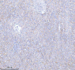 Immunohistochemical staining of SASS6 using anti-SASS6 antibody. SASS6 was detected in a paraffin-embedded section of human cervix squamous cell carcinoma tissue. Heat mediated antigen retrieval was performed in EDTA buffer (pH 8.0, epitope retrieval solution). The tissue section was blocked with 10% goat serum. The tissue section was then incubated with 2 ug/ml rabbit anti-SASS6 antibody overnight at 4oC. Peroxidase Conjugated Goat Anti-rabbit IgG was used as secondary antibody and incubated for 30 minutes at 37oC. The tissue section was developed using an HRP secondary and DAB substrate.