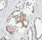Immunohistochemical staining of SASS6 using anti-SASS6 antibody. SASS6 was detected in a paraffin-embedded section of human rectum adenocarcinoma tissue. Heat mediated antigen retrieval was performed in EDTA buffer (pH 8.0, epitope retrieval solution). The tissue section was blocked with 10% goat serum. The tissue section was then incubated with 2 ug/ml rabbit anti-SASS6 antibody overnight at 4oC. Peroxidase Conjugated Goat Anti-rabbit IgG was used as secondary antibody and incubated for 30 minutes at 37oC. The tissue section was developed using an HRP secondary and DAB substrate.