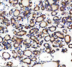 Immunohistochemical staining of Teneurin 1/TENM1 using anti-TENM1 antibody. Teneurin 1/TENM1 was detected in a paraffin-embedded section of human thyroid cancer tissue. Heat mediated antigen retrieval was performed in EDTA buffer (pH 8.0, epitope retrieval solution). The tissue section was blocked with 10% goat serum. The tissue section was then incubated with 2 ug/ml rabbit anti-TENM1 antibody overnight at 4oC. Peroxidase Conjugated Goat Anti-rabbit IgG was used as secondary antibody and incubated for 30 minutes at 37oC. The tissue section was developed using an HRP secondary and DAB substrate.