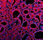 Immunofluorescent staining of Teneurin 1/TENM1 using anti-TENM1 antibody (red). Teneurin 1/TENM1 was detected in a paraffin-embedded section of human thyroid cancer tissue. Heat mediated antigen retrieval was performed in EDTA buffer (pH 8.0, epitope retrieval solution). The tissue section was blocked with 10% goat serum. The tissue section was then incubated with 5 ug/ml rabbit anti-TENM1 antibody overnight at 4oC. Cy3 Conjugated Goat Anti-Rabbit IgG was used as secondary antibody at 1:500 dilution and incubated for 30 minutes at 37oC. The section was counterstained with DAPI nuclear stain (blue). Visualize using a fluorescence microscope and filter sets appropriate for the label used.
