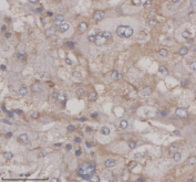 Immunohistochemical staining of SERPINE2 using anti-SERPINE2 antibody. SERPINE2 was detected in a paraffin-embedded section of human adrenal pheochromocytoma tissue. Heat mediated antigen retrieval was performed in EDTA buffer (pH 8.0, epitope retrieval solution). The tissue section was blocked with 10% goat serum. The tissue section was then incubated with 2 ug/ml rabbit anti-SERPINE2 antibody overnight at 4oC. Peroxidase Conjugated Goat Anti-rabbit IgG was used as secondary antibody and incubated for 30 minutes at 37oC. The tissue section was developed using an HRP secondary and DAB substrate.
