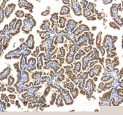 Immunohistochemical staining of RBM17 using anti-RBM17 antibody. RBM17 was detected in a paraffin-embedded section of human ovarian cancer tissue. Heat mediated antigen retrieval was performed in EDTA buffer (pH 8.0, epitope retrieval solution). The tissue section was blocked with 10% goat serum. The tissue section was then incubated with 2 ug/ml rabbit anti-RBM17 antibody overnight at 4oC. Peroxidase Conjugated Goat Anti-rabbit IgG was used as secondary antibody and incubated for 30 minutes at 37oC. The tissue section was developed using an HRP secondary and DAB substrate.