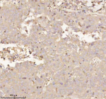 Immunohistochemical staining of PTCD1 using anti-PTCD1 antibody. PTCD1 was detected in a paraffin-embedded section of human breast cancer tissue. Heat mediated antigen retrieval was performed in EDTA buffer (pH 8.0, epitope retrieval solution). The tissue section was blocked with 10% goat serum. The tissue section was then incubated with 2 ug/ml rabbit anti-PTCD1 antibody overnight at 4oC. Peroxidase Conjugated Goat Anti-rabbit IgG was used as secondary antibody and incubated for 30 minutes at 37oC. The tissue section was developed using an HRP secondary and DAB substrate.
